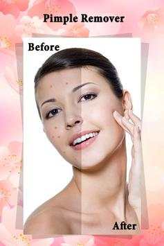Pimple Remover : Beauty Plus screenshot 1