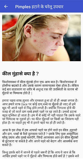 Pimples हटाने के घरेलू उपाय screenshot 2