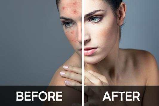 Pimple Remover-Pimple Eraser screenshot 6
