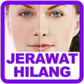 Cara Menghilangkan Jerawat