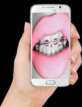 Real Braces teeth screenshot 3