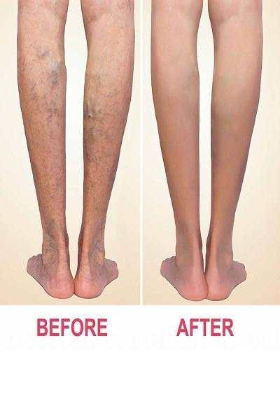 Sclerotherapy screenshot 2
