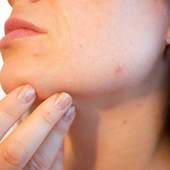 Treating Acne during Pregnancy 1.2.1