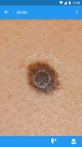 Molexplore - Melanoma & Skin Cancer App screenshot 4