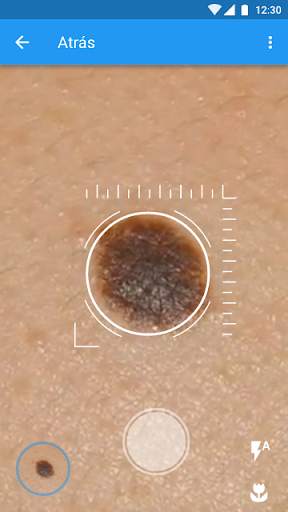 Molexplore “Skin Cancer App” screenshot 4