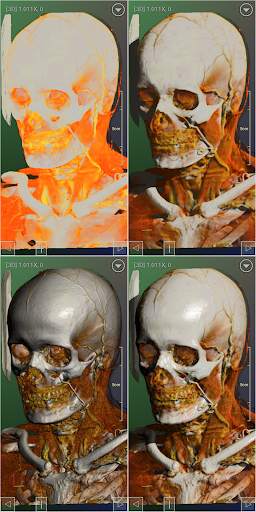 DroidRender - 3D DICOM viewer स्क्रीनशॉट 2