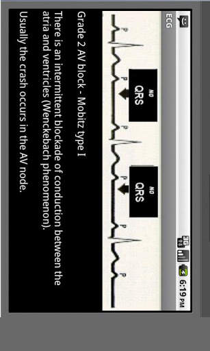 Electrocardiogram ECG Types screenshot 5