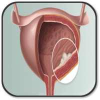 Treating Bladder Cancer