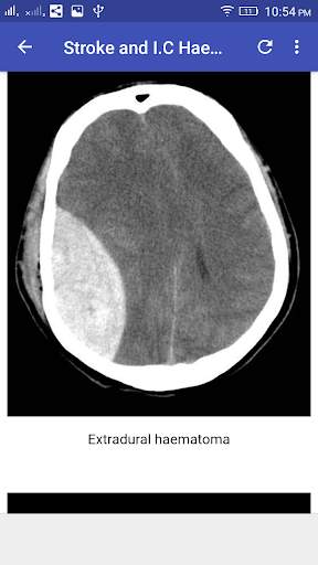 CT Brain Interpretation 6 تصوير الشاشة