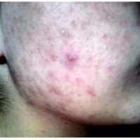 How To Get Rid of Pimples/Acne on 9Apps