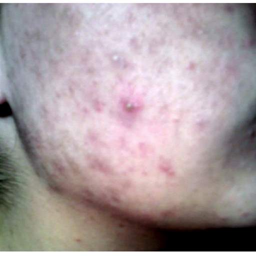 How To Get Rid of Pimples/Acne 1.0