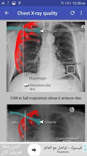 Chest X-Ray Interpretation screenshot 5