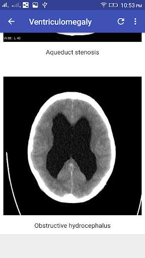 CT Brain Interpretation 4 تصوير الشاشة