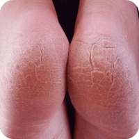 Get Rid of Cracked Heels icon