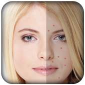 Pimple Remover-Pimple Eraser 4.0