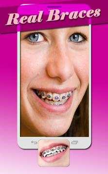 Real Braces Teeth Booth Pro screenshot 4