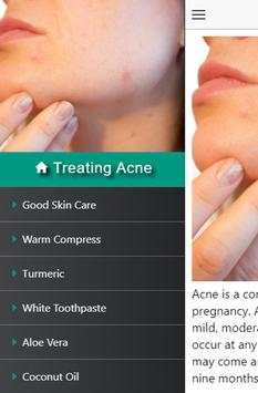 Treating Acne during Pregnancy screenshot 2