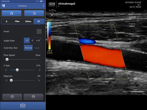 SONON Ultrasound App screenshot 1
