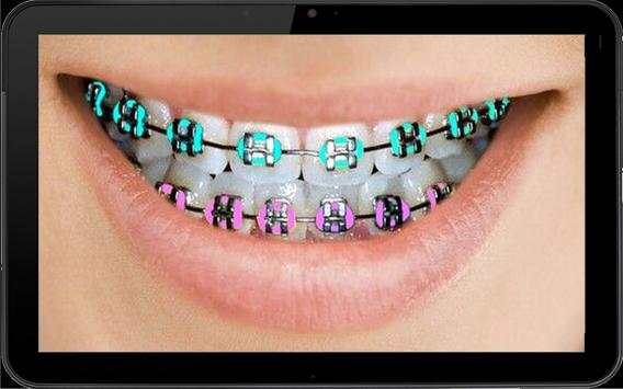 Real Braces teeth screenshot 6