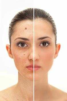 Acne Remover Photo Editor screenshot 1