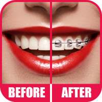 Braces 2.0 on 9Apps