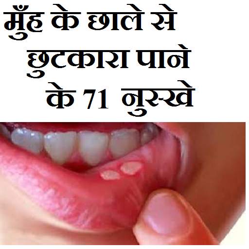 मुँह के छाले से छुटकारा पाने के 71 उपाय 1.3