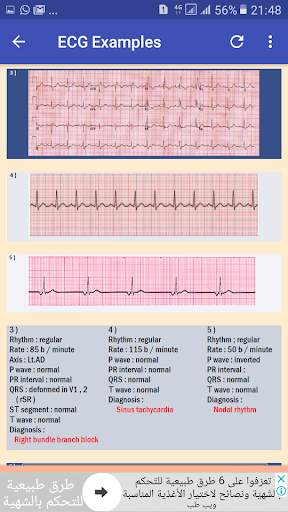 ECG Interpretation Made Easy скриншот 6