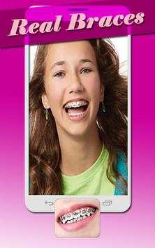 Real Braces Teeth Booth Pro screenshot 1
