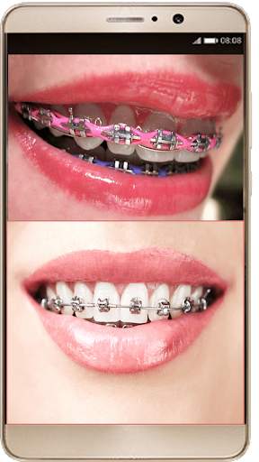 Braces Photo Editor - Braces For Your Teeth screenshot 3