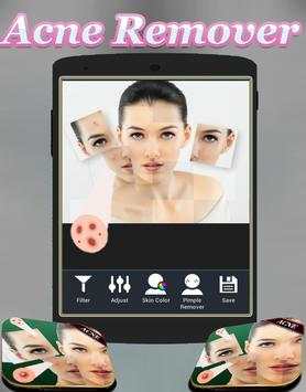 Acne Remover Photo Editor - Pimple remover screenshot 1