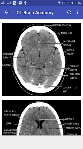 CT Brain Interpretation 3 تصوير الشاشة