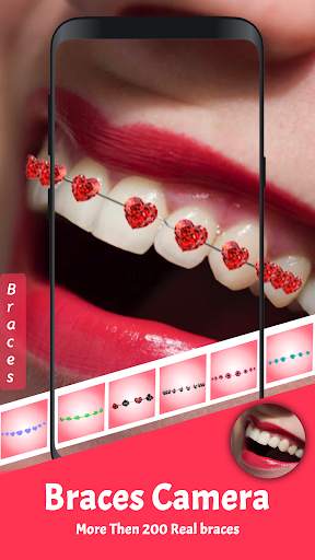Braces 2019 - Braces Yourself Prank screenshot 1