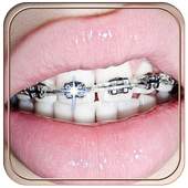 Braces 1.0