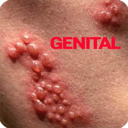 Genital Herpes 1.0.0