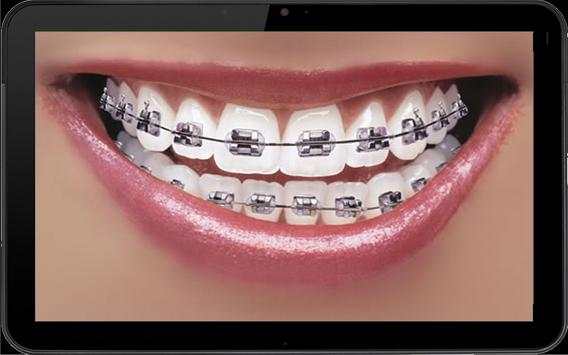 Real Braces teeth screenshot 5