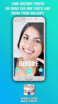 Before and After braces Photo screenshot 3