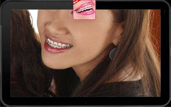 Kawat gigi Gigi Kamera moto screenshot 5