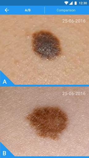 Molexplore “Skin Cancer App” screenshot 3