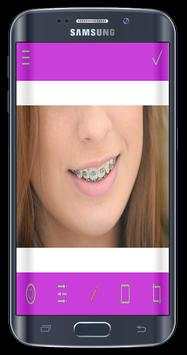 Top Design Braces teeth screenshot 4