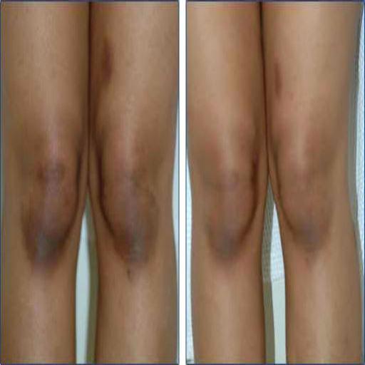 How to bleach your knee  (Guide) icon