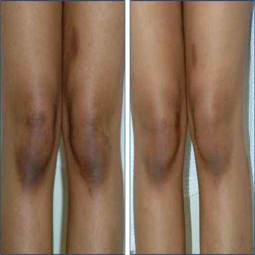 How to bleach your knee  (Guide) 1.2