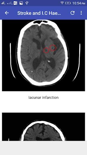 CT Brain Interpretation 5 تصوير الشاشة