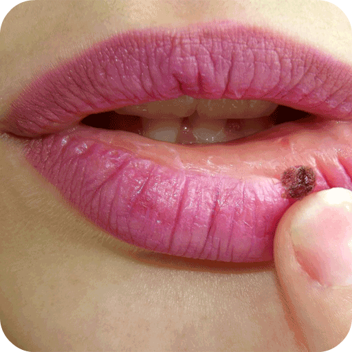 Cold Sores Treatment icon