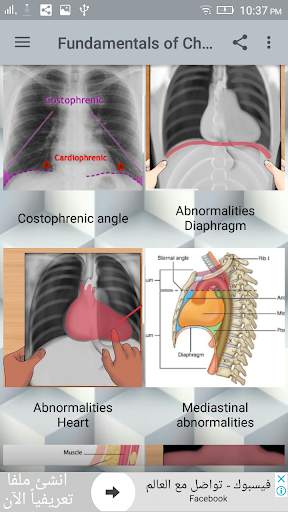 Chest X-Ray Interpretation screenshot 3