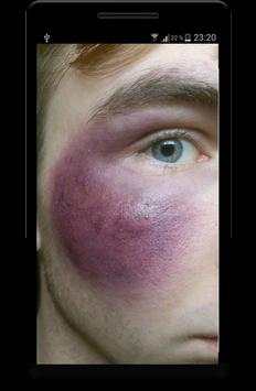 Injury Photo Faker Editor screenshot 1