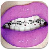 Braces- HD Camera Braces Booth 1.0