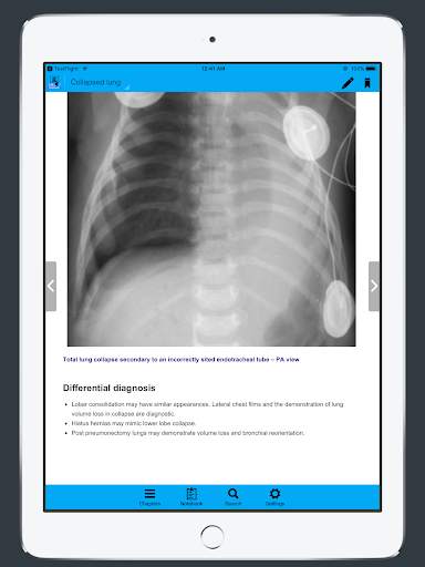 CXR FlashCards - Reference app for Chest X-rays screenshot 6