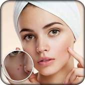 Pimple Remover : Beauty Plus 1.0
