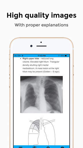 CXR FlashCards - Reference app for Chest X-rays screenshot 1