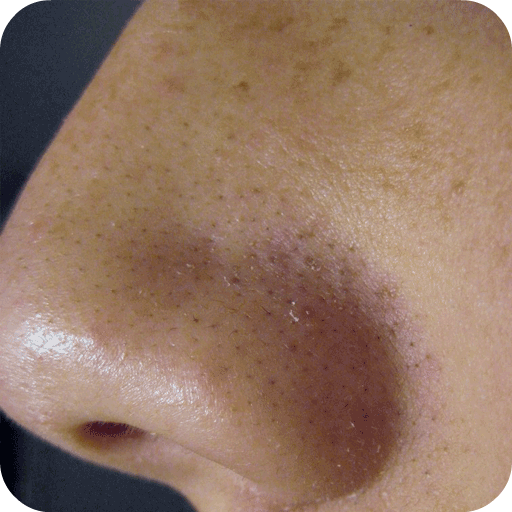Remove Blackheads Home Remedy icon